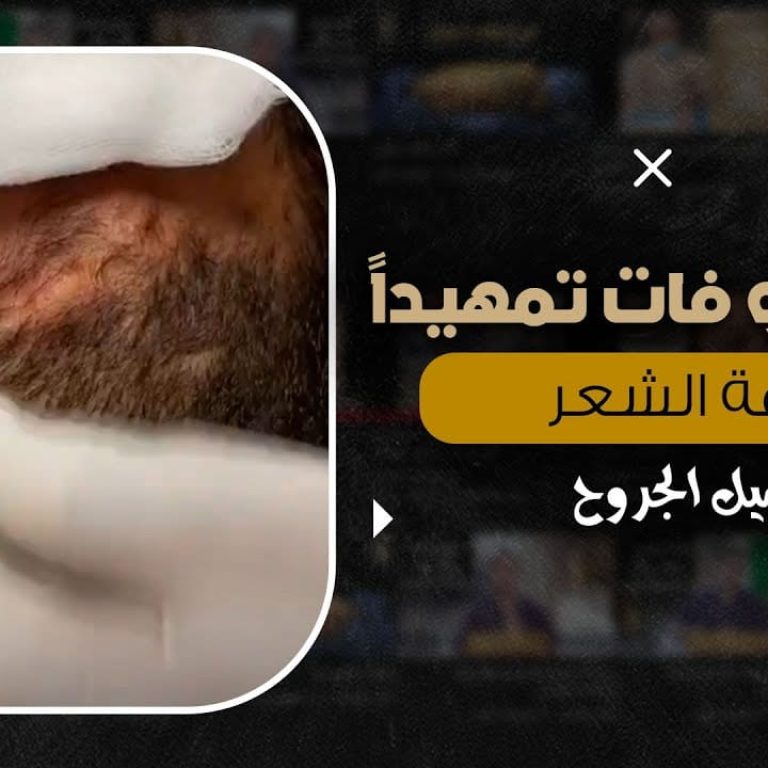 حقن النانو فات تمهيداً لزراعة الشعر للجروح