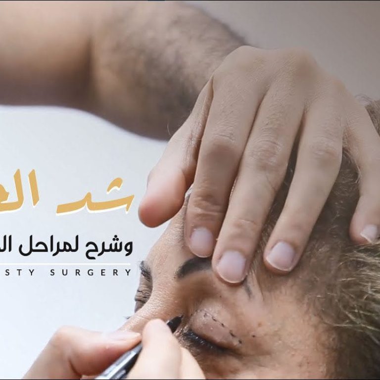 شد الجفون وشرح لمراحل العميلة بالتفصيل