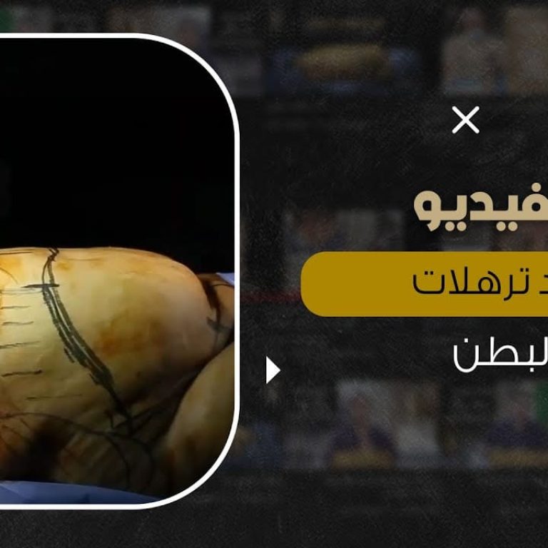 التخلص من ترهلات البطن بدون مجهود وبدون ألم