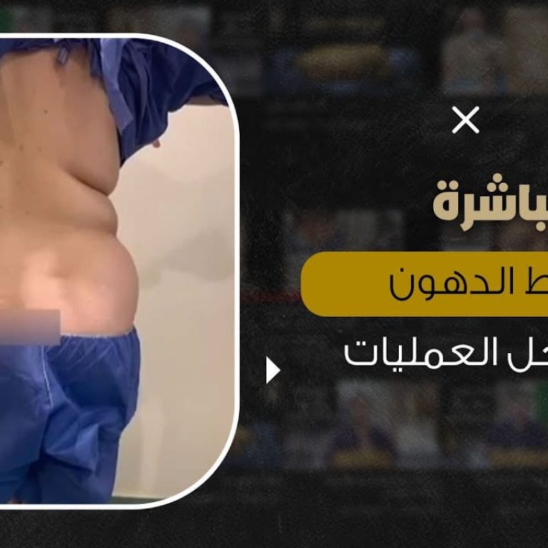 شفط الدهون مباشرة من داخل غرفة العمليات