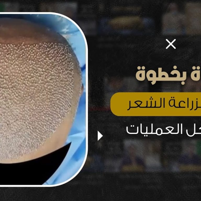 خطوة بخطوة عملية زراعة الشعر الطبيعي