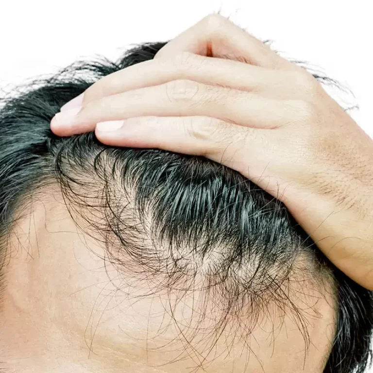 أدوية تساقط الشعر