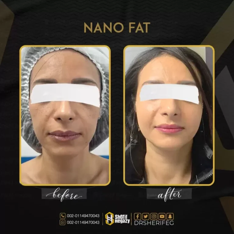 تقنية النانو فات في جراحات التجميل
